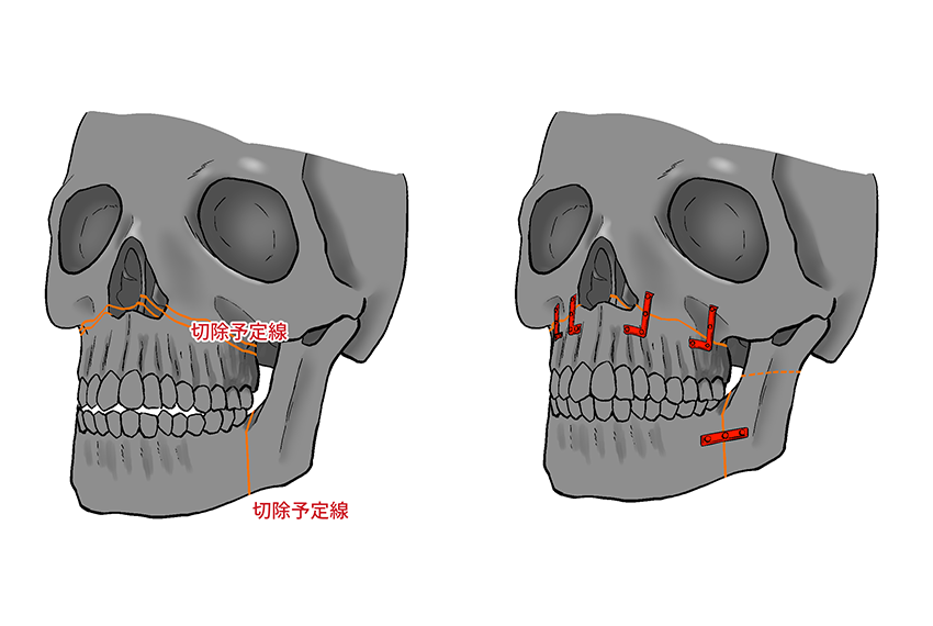 上顎骨切り術 ルフォー 型骨切り術 表参道スキンクリニック 顎顔面形成術