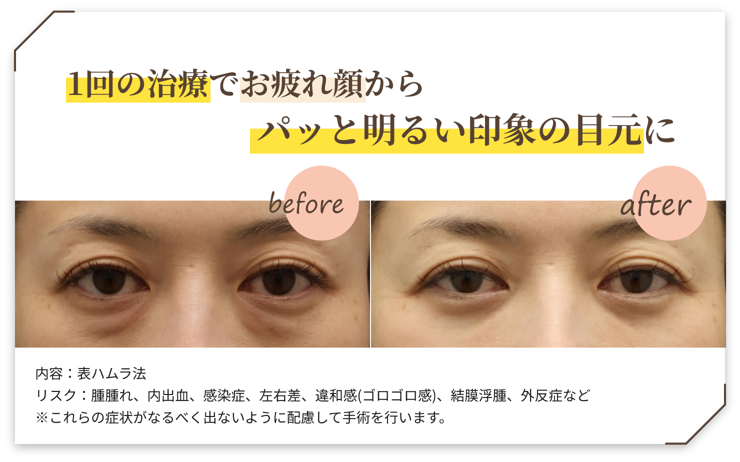 １回の治療でお疲れ顔からパっと明るい印象の目元に