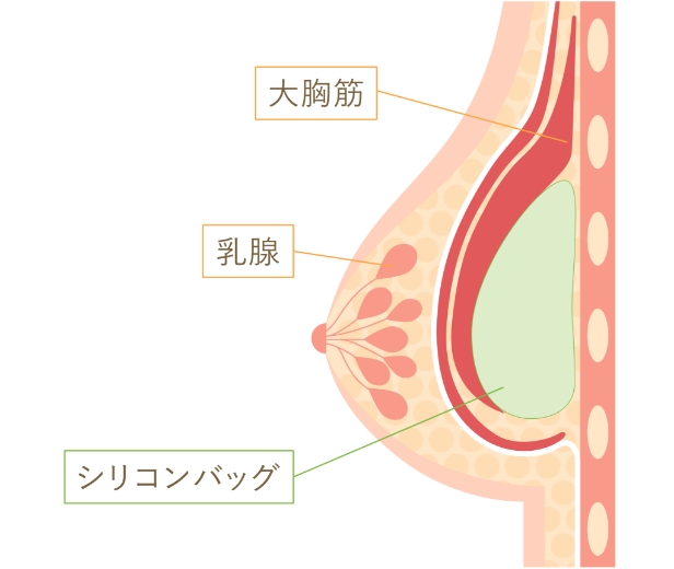 胸筋膜下法
