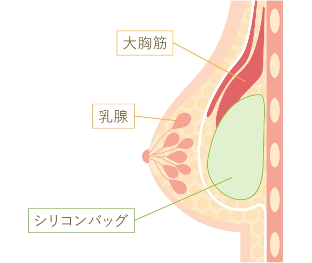 デュアルプレーン法