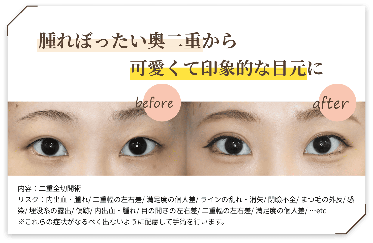 １回の治療でお疲れ顔からパっと明るい印象の目元に