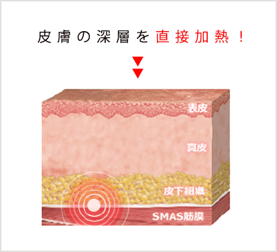 ハイフ(HIFU)