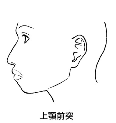 上顎前突症