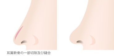 鼻尖形成術