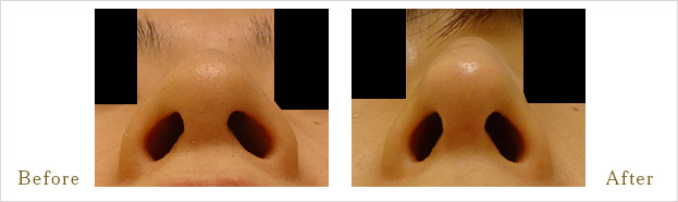 鷲鼻形成術・耳介軟骨移植術