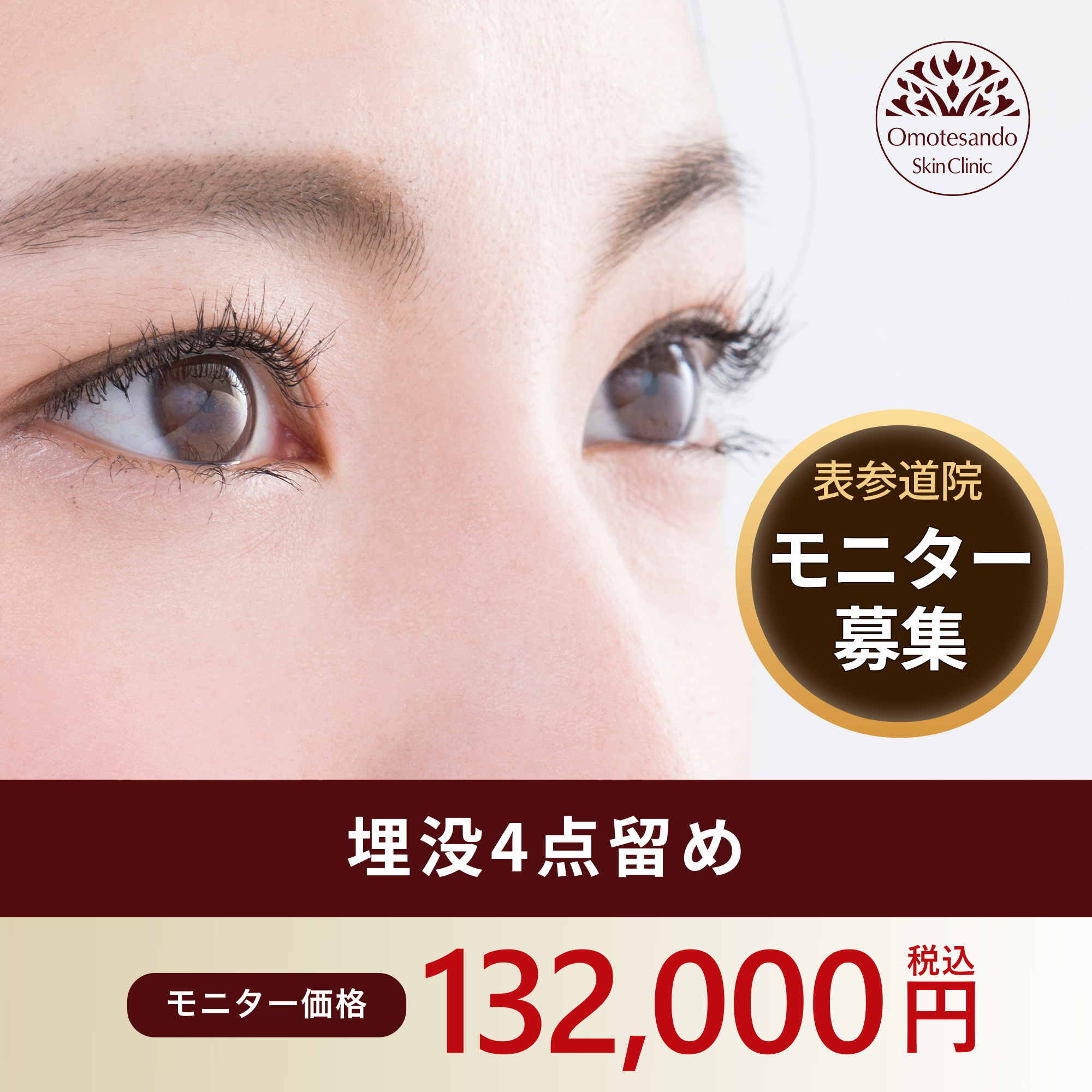 埋没4点留め