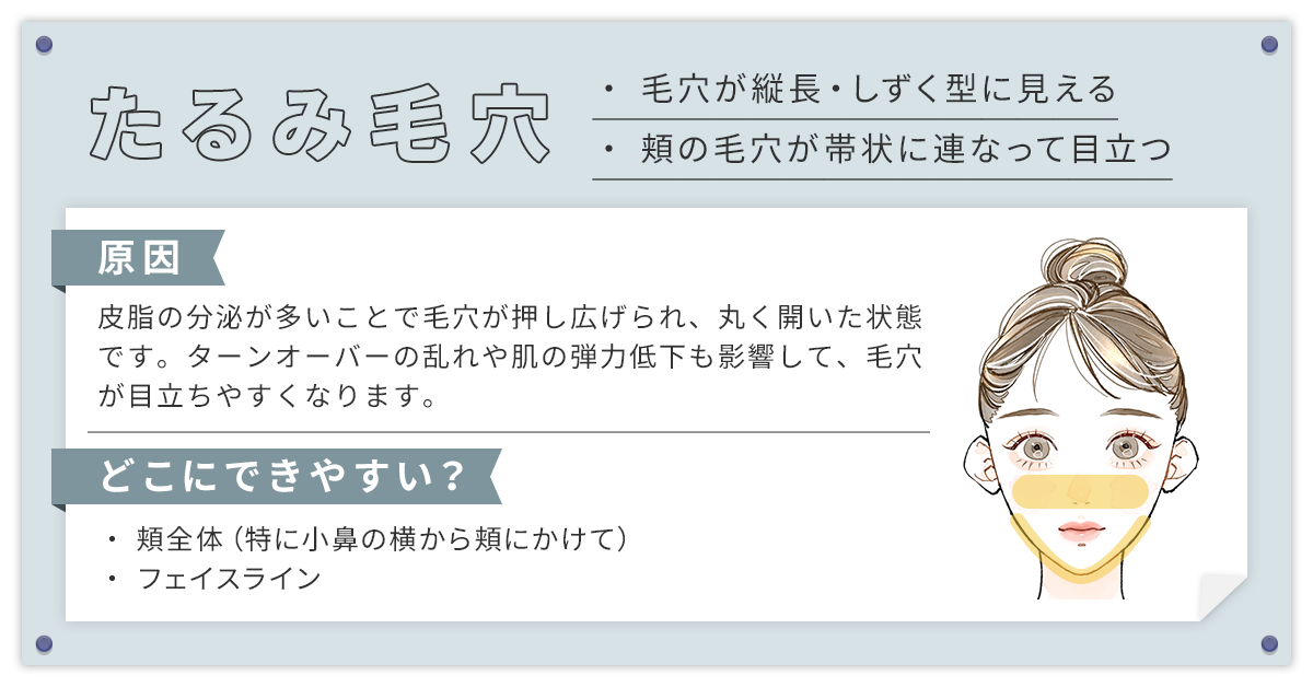 たるみ毛穴（帯状毛穴）
