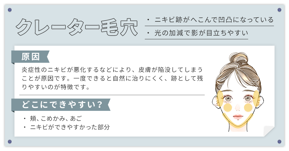 クレーター毛穴（ニキビ跡毛穴）
